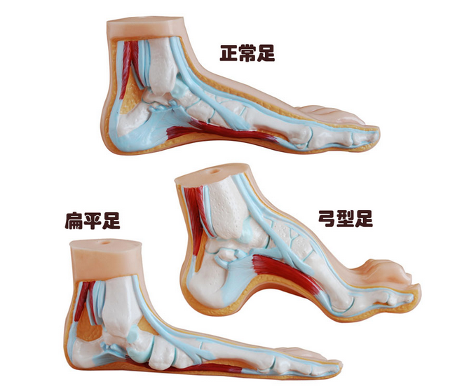 正常足、扁平足、弓型足模型